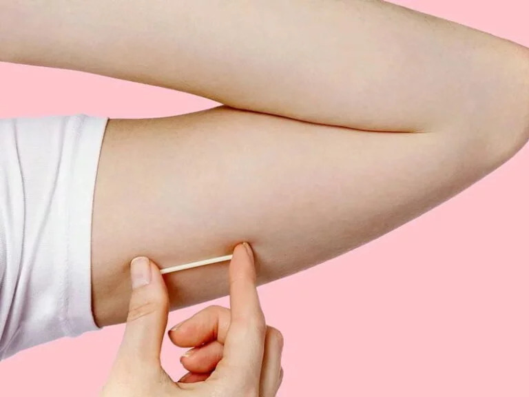 implante hormonal implanon 768x576.jpg